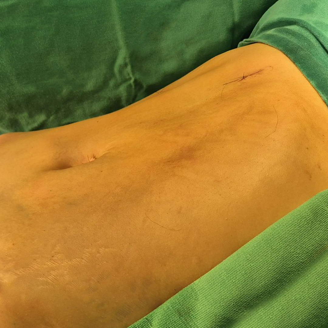 Registro de cuidado cirúrgico abdominal